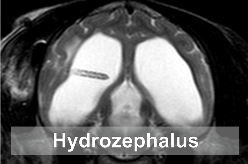 Hydrozephalus