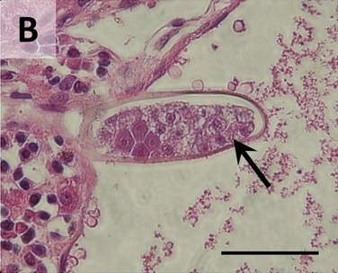 Leberkrebs_klein