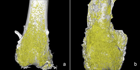 Angiogenesis