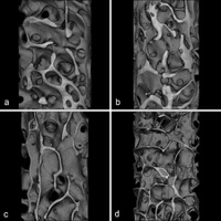 T1 Iliac crest