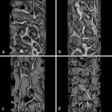 T1 Iliac crest